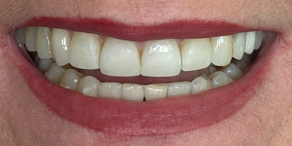 Photo of a close-up smile showing natural, evenly aligned teeth with healthy gums.