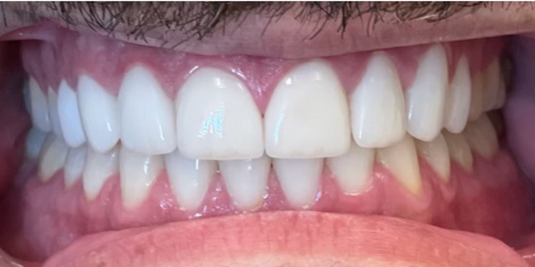 Photo of a close-up view of teeth showing improved alignment and whiteness after treatment.