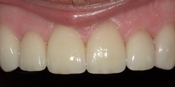 Photo of a close-up view of teeth showing improved alignment, whiteness, and smooth enamel after treatment.