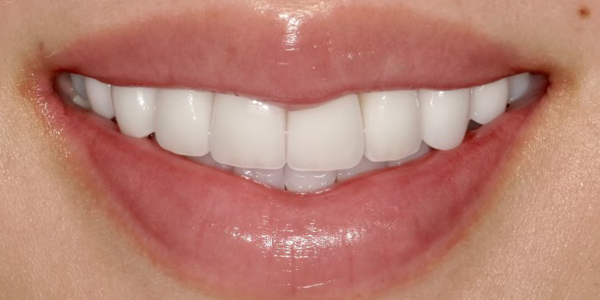 Photo of a close-up smile showing bright, straight teeth with healthy gums.
