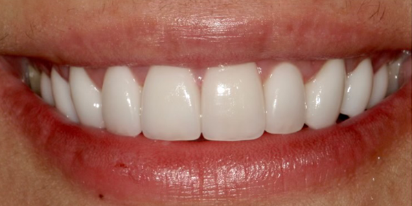 Photo of a close-up smile showing bright, white, and evenly aligned teeth with healthy gums.