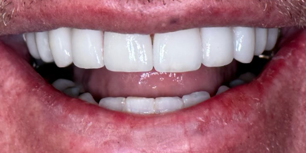 Photo of a close-up smile showing bright, white, and evenly aligned teeth with healthy gums.
