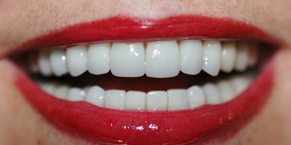 Photo of a close-up smile with bright white teeth and bold red lipstick.