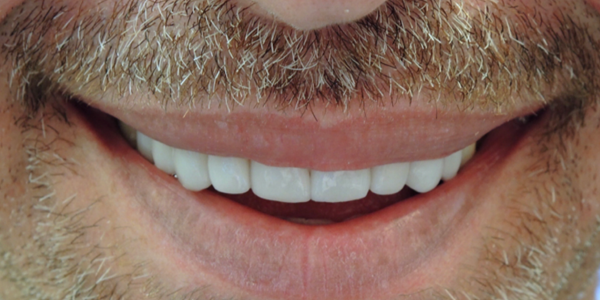 Photo of a close-up smile showing bright, white teeth with healthy gums.