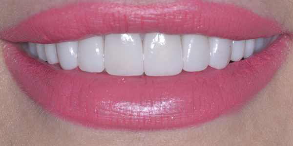 Photo of a close-up smile with bright white teeth and soft pink lipstick.  Copiar Pergunte Explique  Traduza(pt-PT)