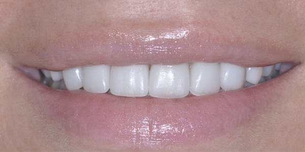 Photo of a close-up smile showing straight, white teeth with healthy gums.  Copiar Pergunte Explique  Traduza(pt-PT)