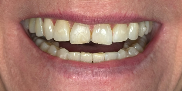 Photo of a close-up smile showing teeth with mild discoloration and slight misalignment.