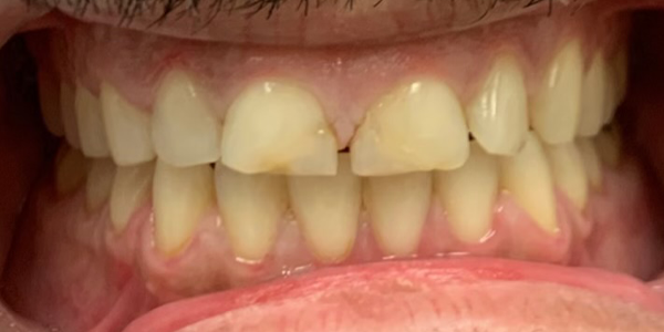 Photo of a close-up view of teeth showing mild discoloration and slight misalignment.