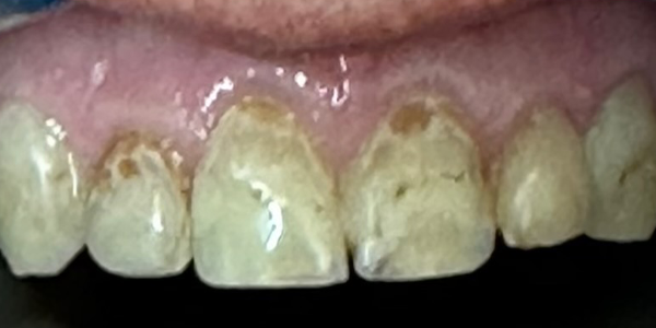 Photo of a close-up view of teeth with visible wear, discoloration, and enamel damage.
