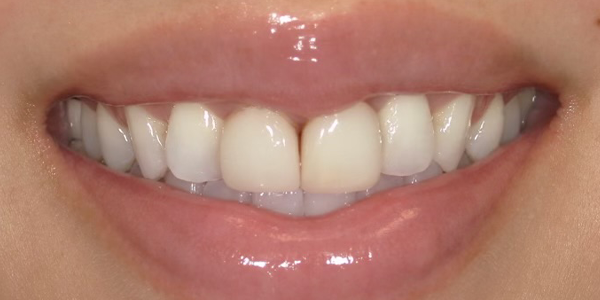 Photo of a close-up smile showing straight, white teeth with healthy gums.
