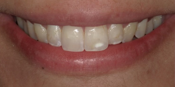Photo of a close-up smile showing natural, evenly aligned teeth with healthy gums.