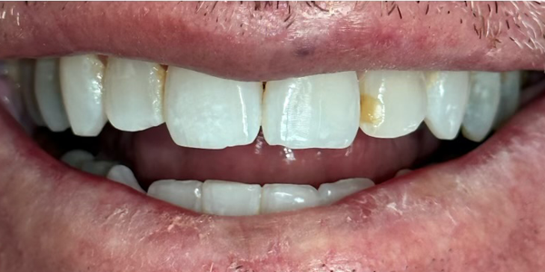 Photo of a close-up smile showing teeth with mild discoloration and slight wear.