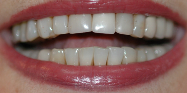 Photo of a close-up smile showing straight, white teeth with healthy gums.