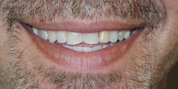 Photo of a close-up smile showing teeth with mild discoloration and slight misalignment.