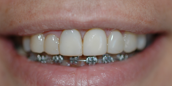 Photo of a close-up smile showing teeth with metal braces.