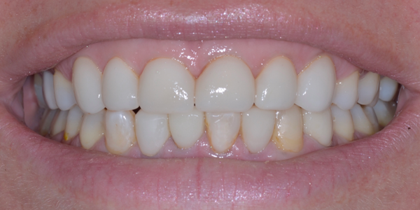 Photo of a close-up smile showing natural, evenly aligned teeth with healthy gums.